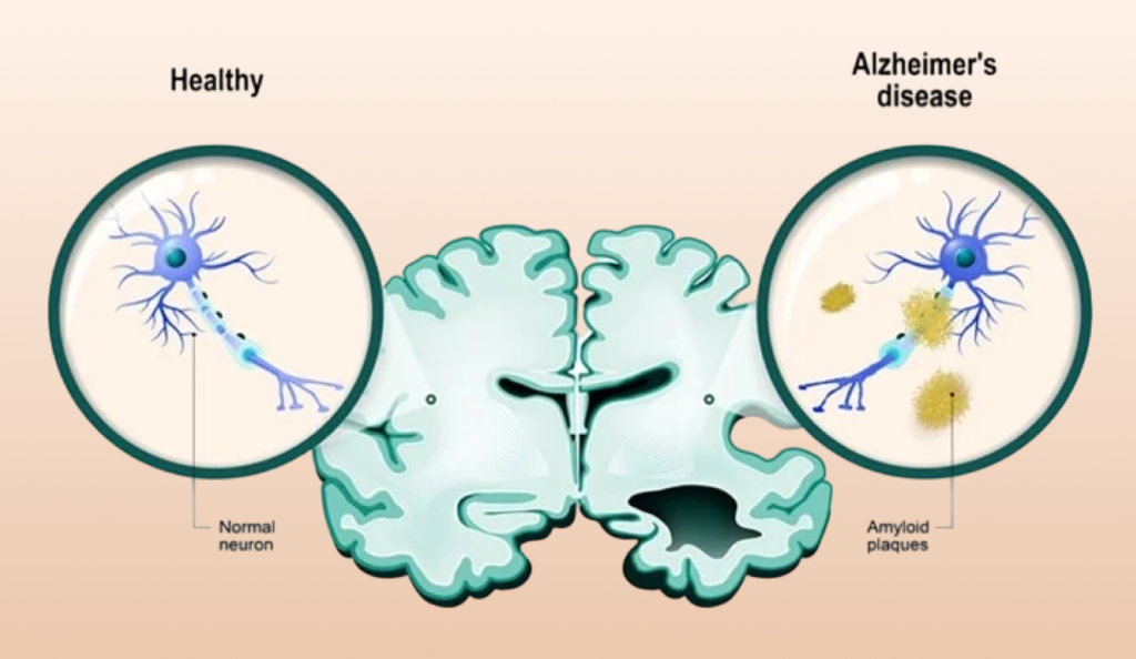Alzheimers