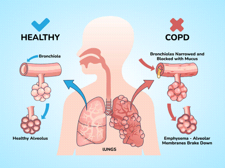 Manage COPD
